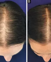 Male and Female Pattern Hair Loss Treatments