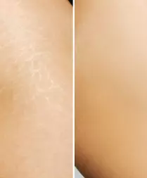 Stretch Mark Removal