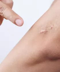 Surgical Scar Removal