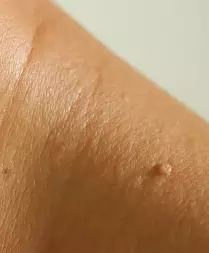 Wart and Skin Tag Removal